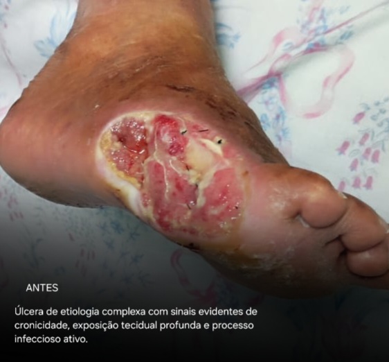 Pé diabético — antes