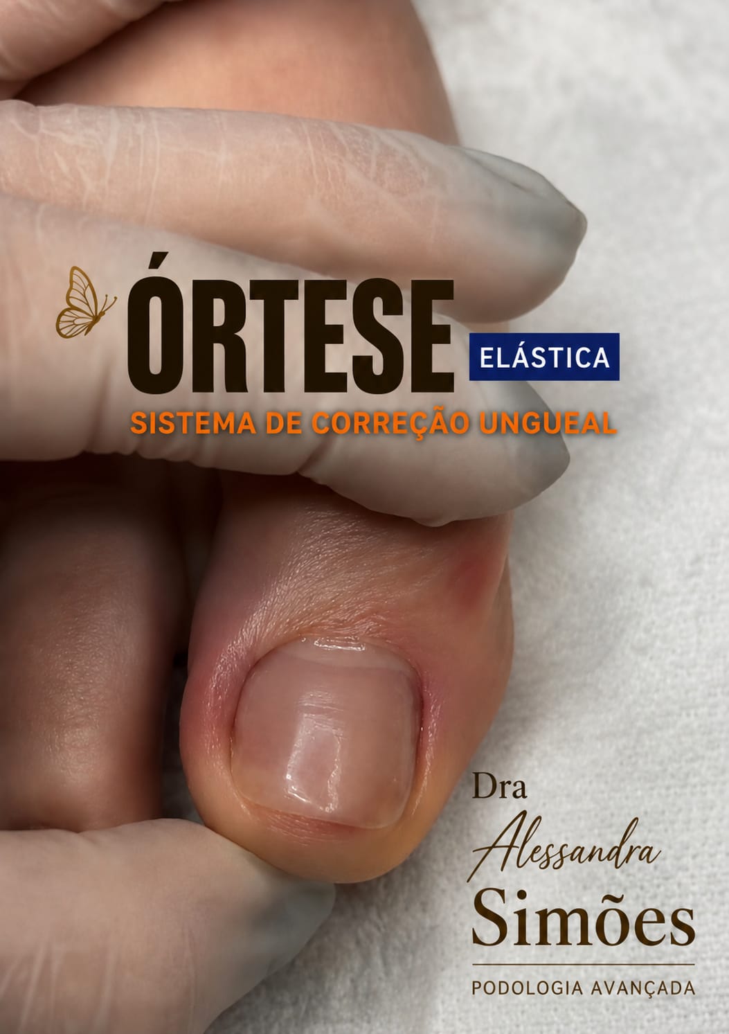 Órtese Elástica — Sistema de Correção Ungueal aplicada por Dra. Alessandra Simões