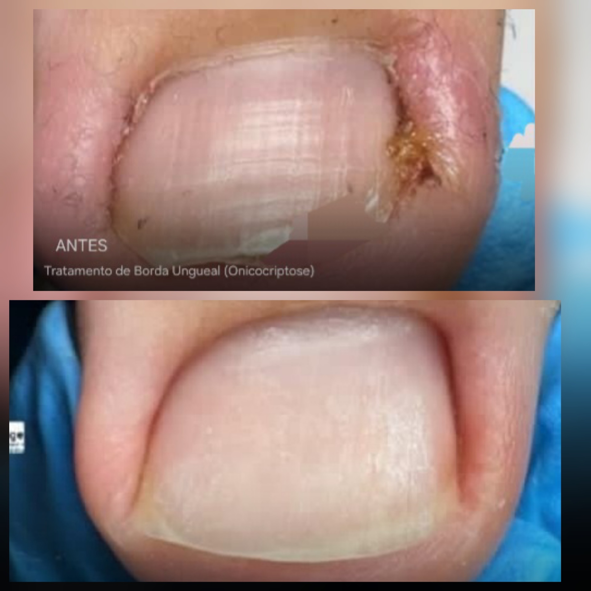 Antes e depois — Tratamento de Borda Ungueal