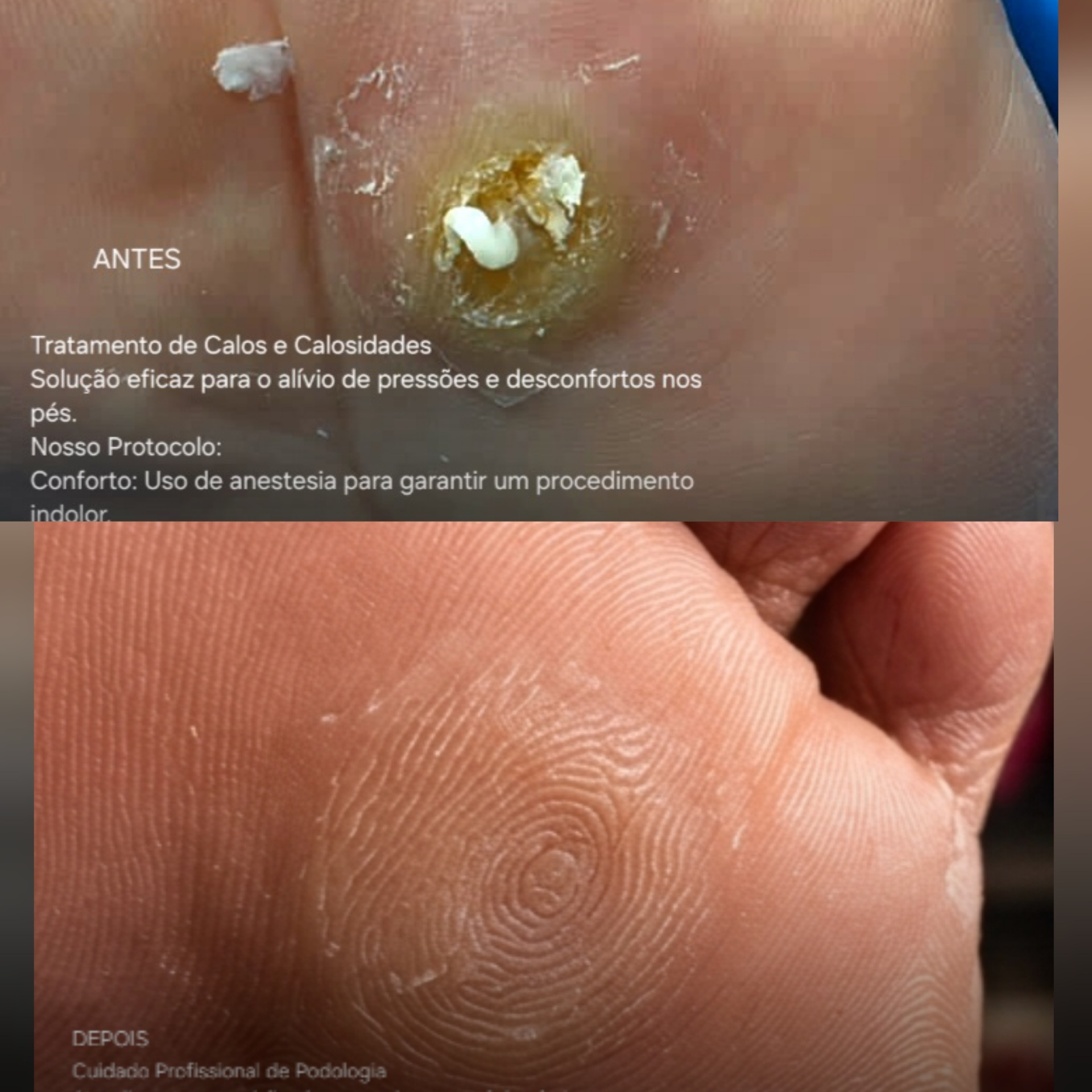 Antes e depois — Tratamento de Calos e Calosidades