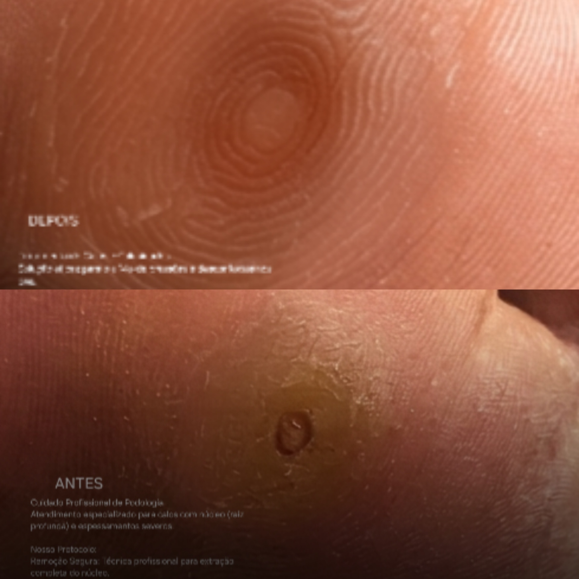Antes e depois — Calos com Núcleo e Espessamentos