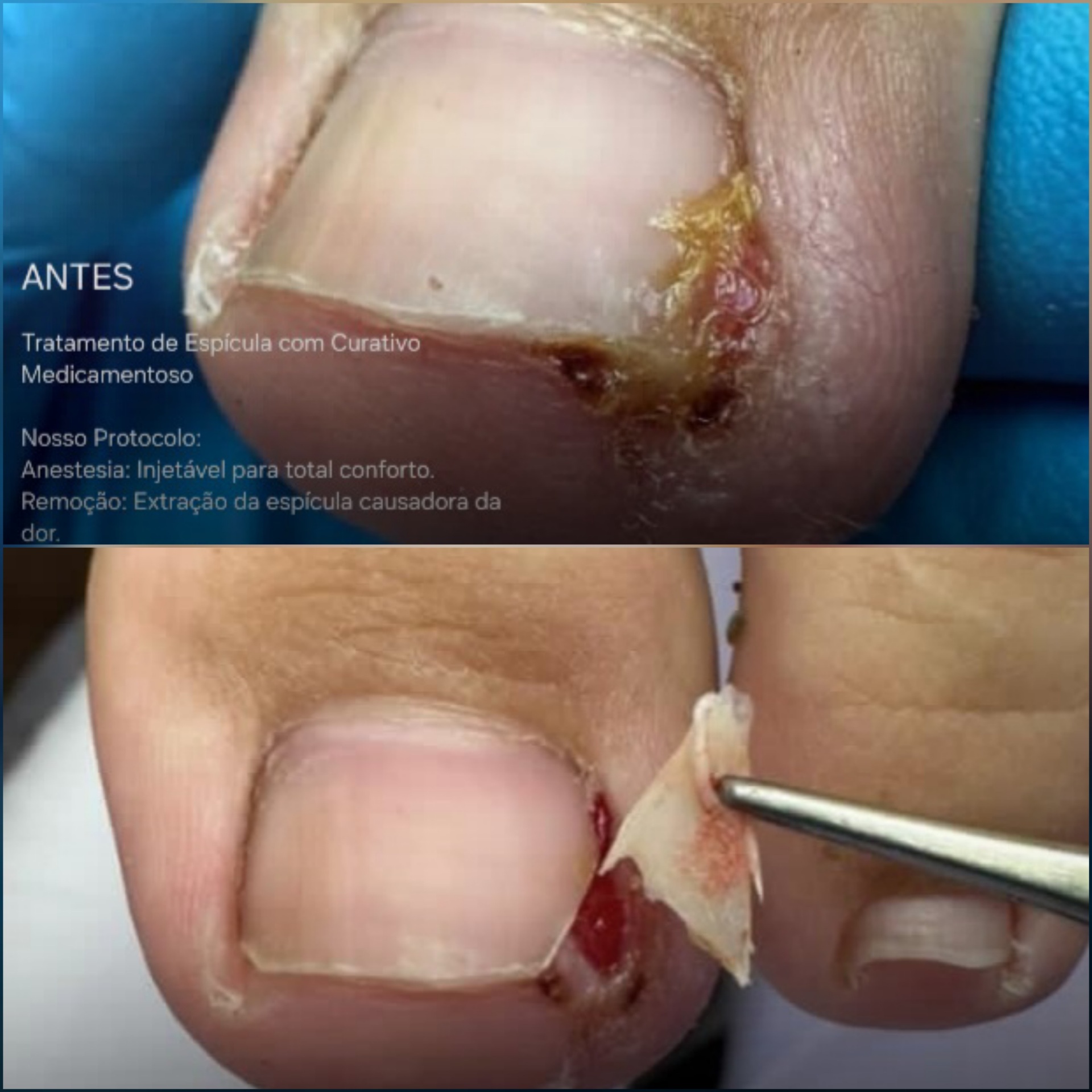 Antes e depois — Tratamento de Espícula com Curativo Medicamentoso