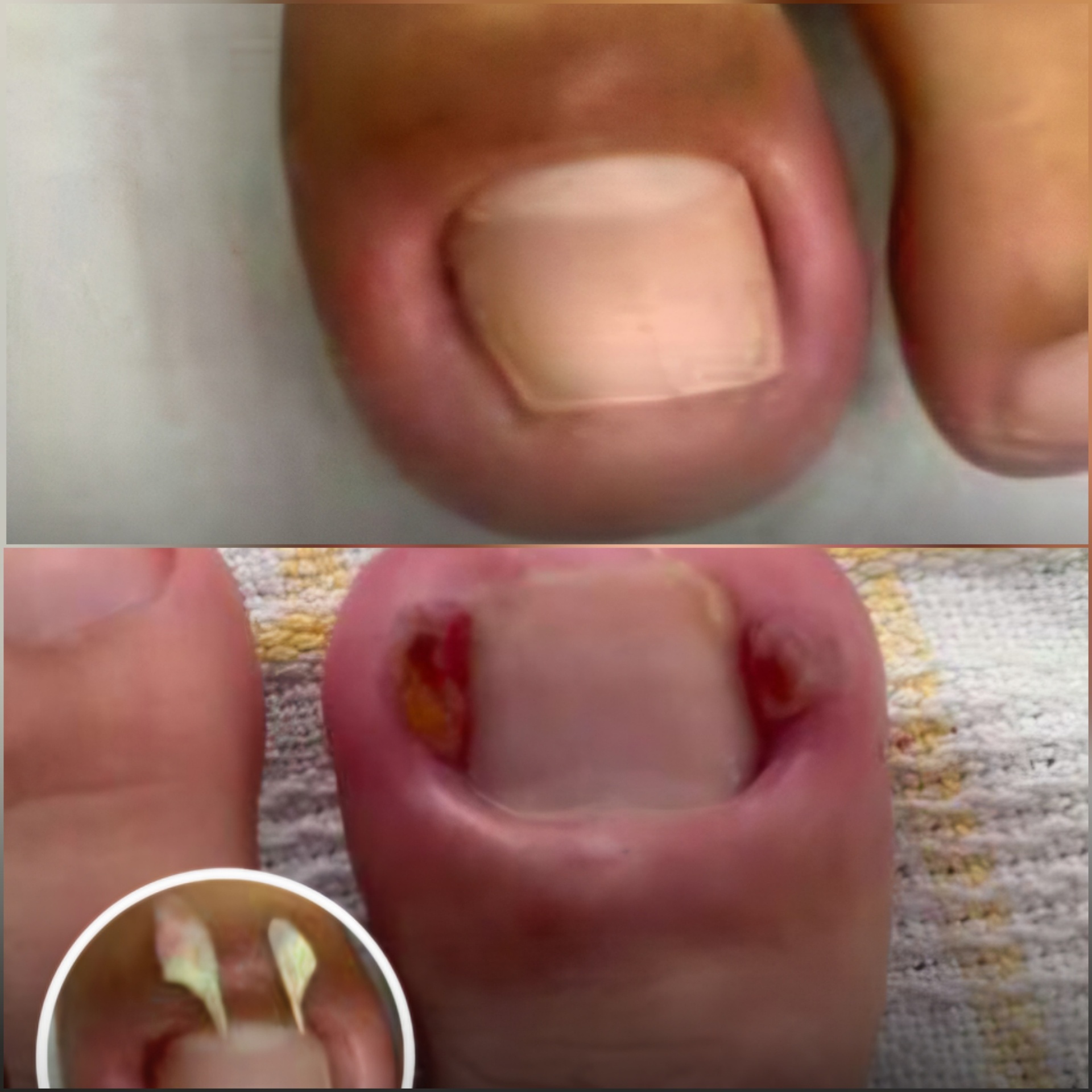 Antes e depois — Granuloma Piogênico (Hálux)