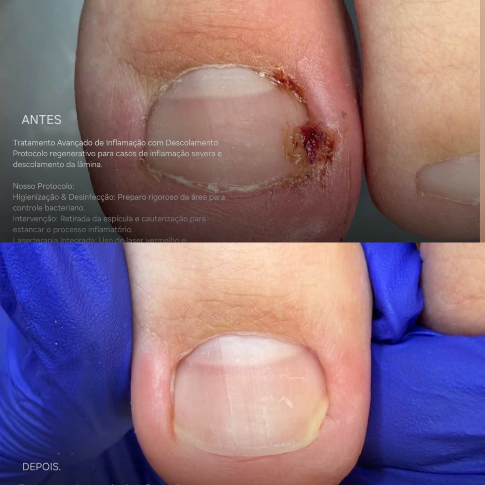 Antes e depois — Inflamação Avançada com Descolamento