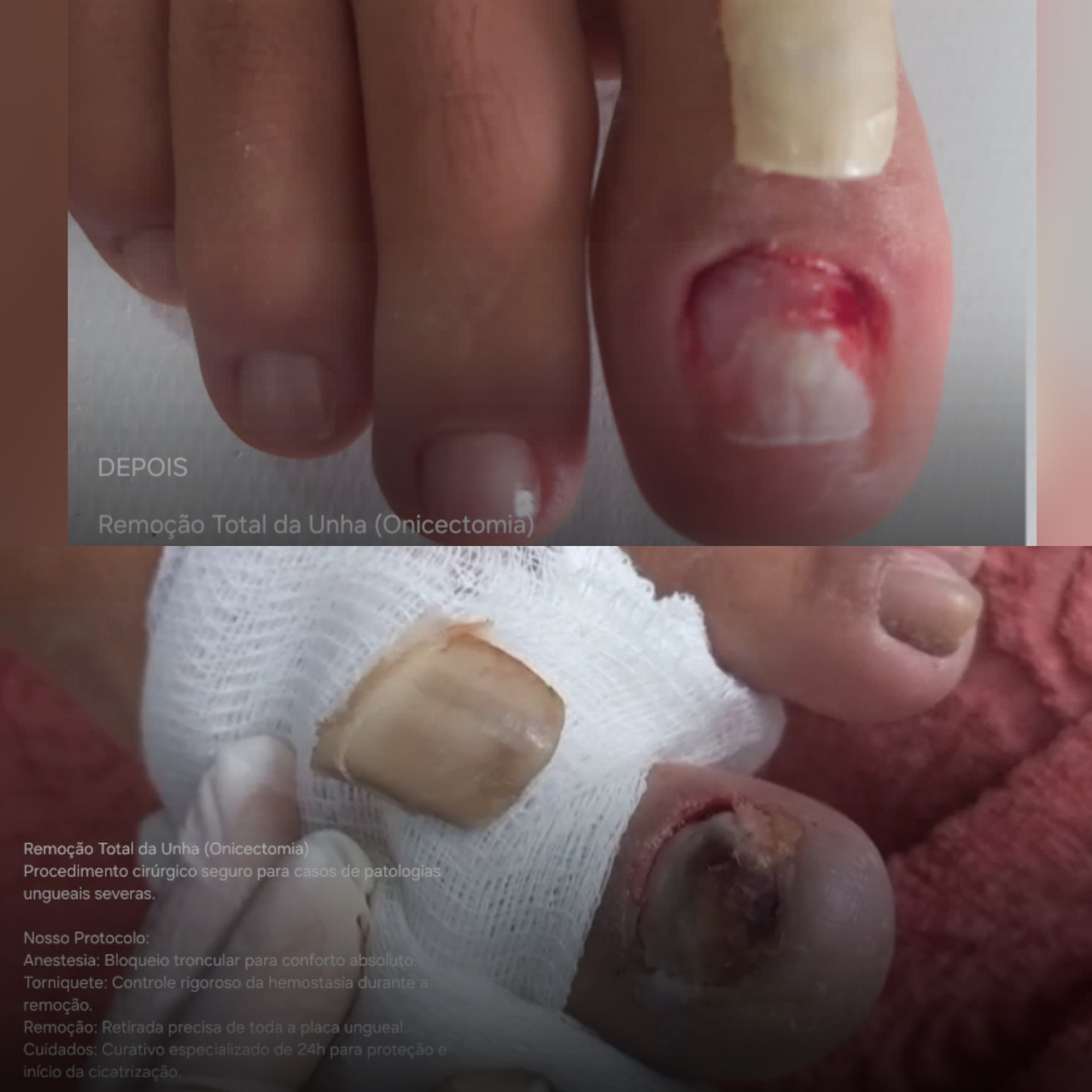 Antes e depois — Remoção Total da Unha (Onicectomia)