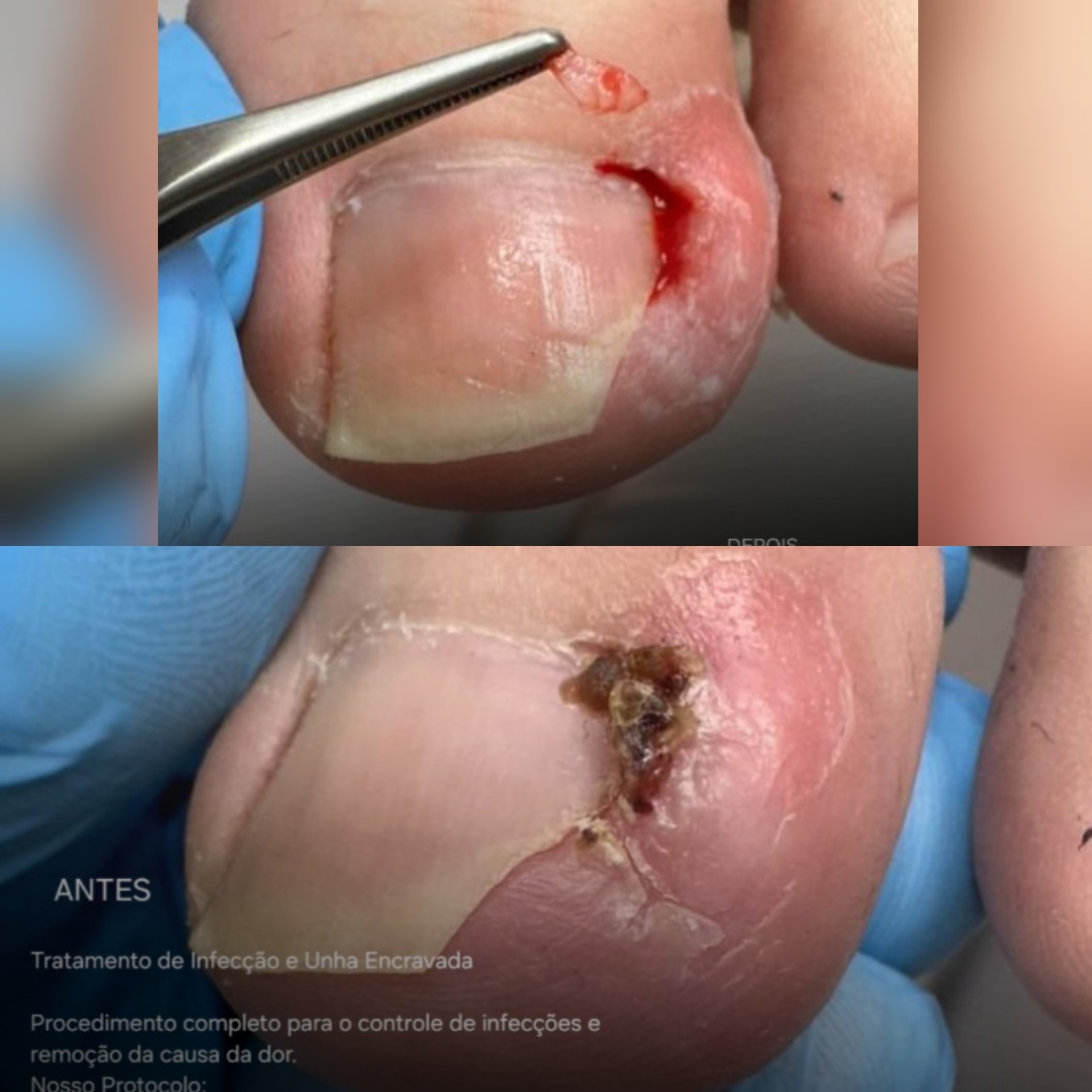 Antes e depois — Onicocriptose (Unha Encravada)