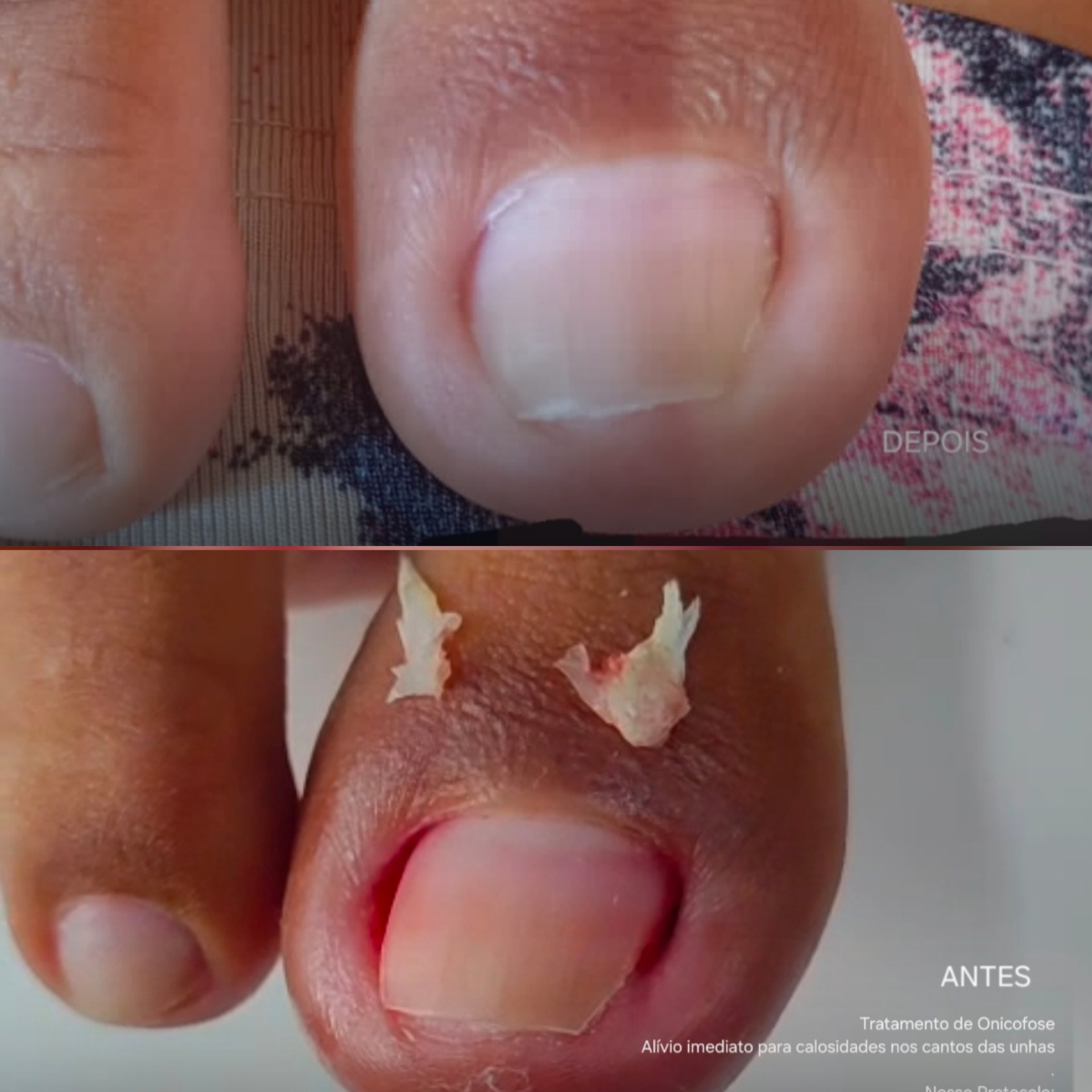 Antes e depois — Tratamento de Onicofose