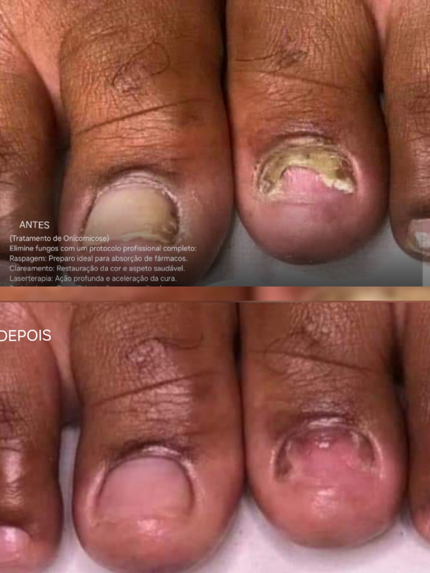 Antes e depois — Tratamento de Onicomicose
