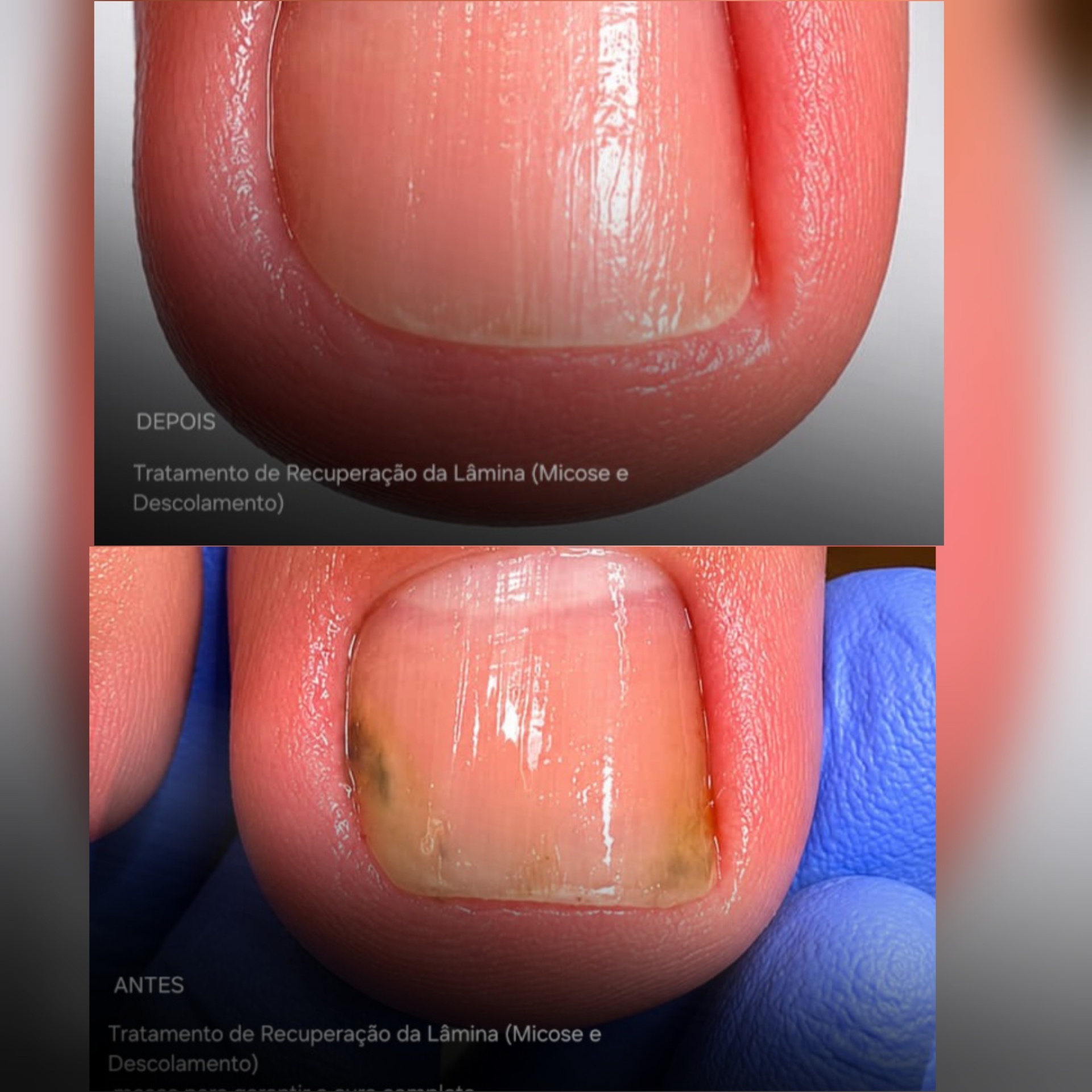 Antes e depois — Recuperação da Lâmina (Micose)