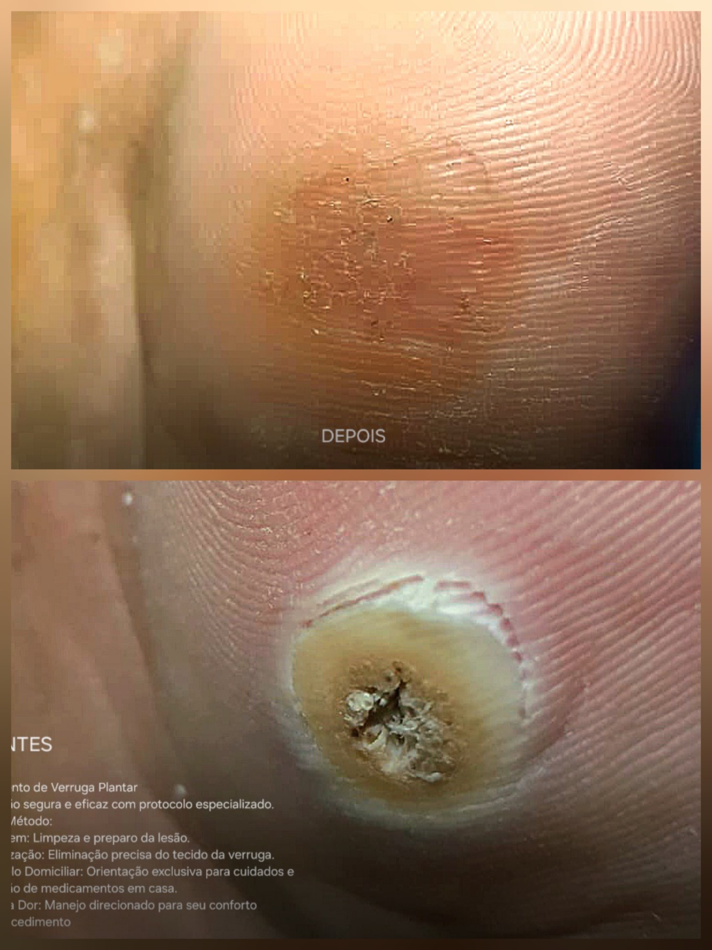 Antes e depois — Tratamento de Verruga Plantar