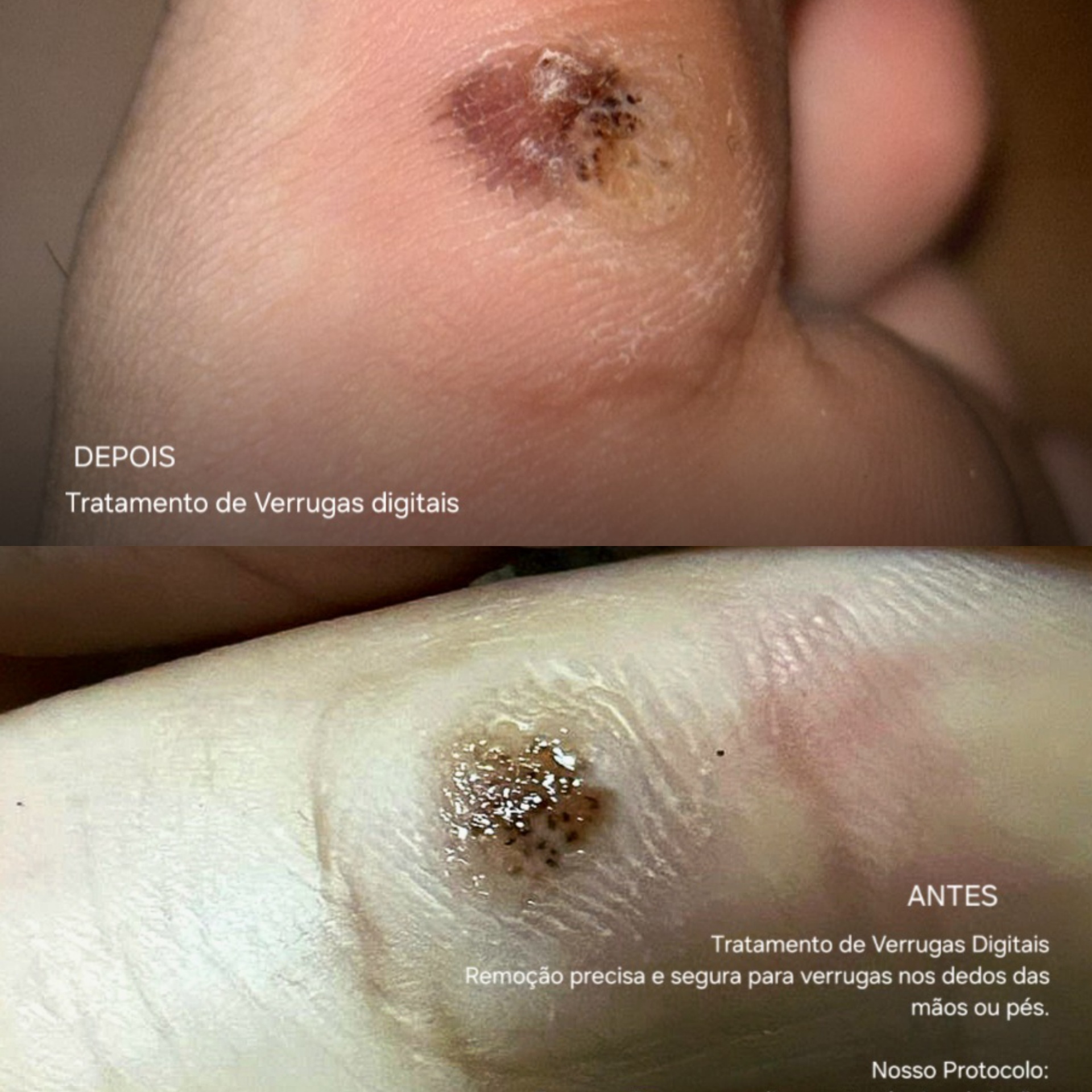Antes e depois — Tratamento de Verrugas Digitais